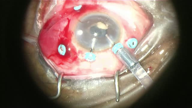 Post Infectious Endophthalmitis: Trends and Techniques [NO SOUND]