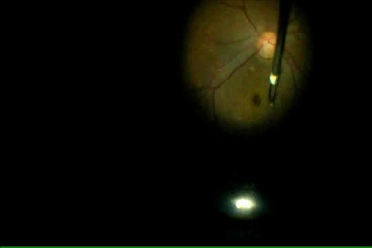Macular Hole Surgery with Inverted Flap Technique