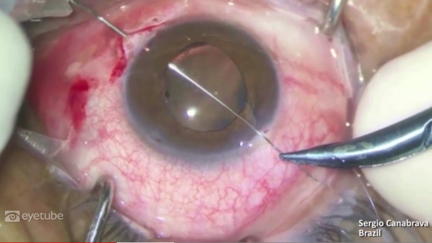 Capsular Tension Ring: Everything You Should Know: Part 2