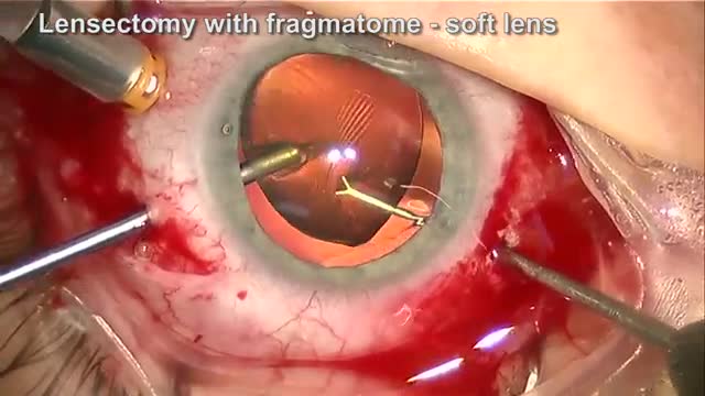 Vitrectomy, Lensectomy, and ACIOL for Ectopia Lentis in Marfan's Syndrome