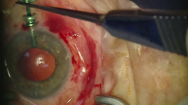 4-Point Gore-Tex Fixated IOL With Anterior Chamber Trocar Infusion