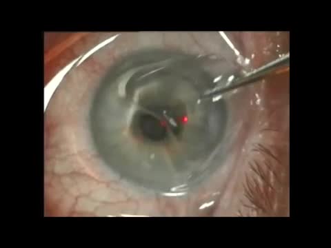 Phototherapeutic Keratectomy - Superficial Keratectomy for Irregular Astigmatism