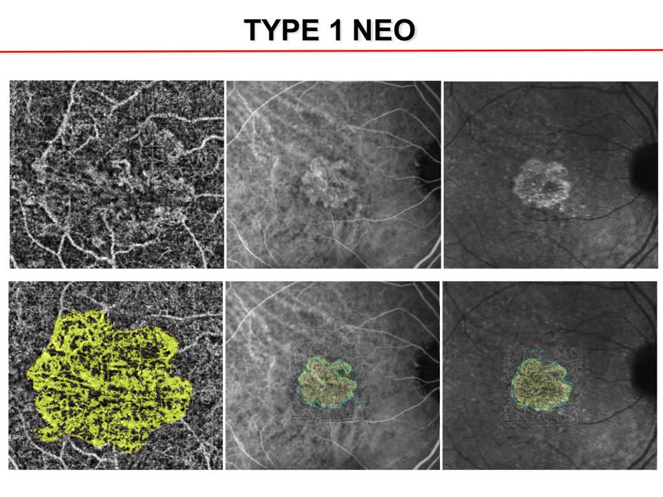 OCT-A Used in the Management of Type 1 Neovascularization