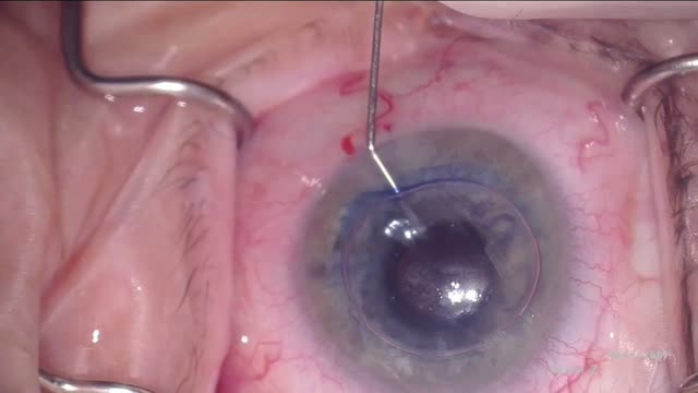 DMEK Harvest and Triple Procedure