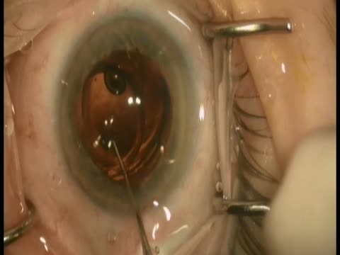 Scaffold IOL Exchange Technique