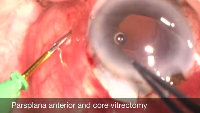 Spontaneous Malignant Glaucoma During Phacotrabeculectomy