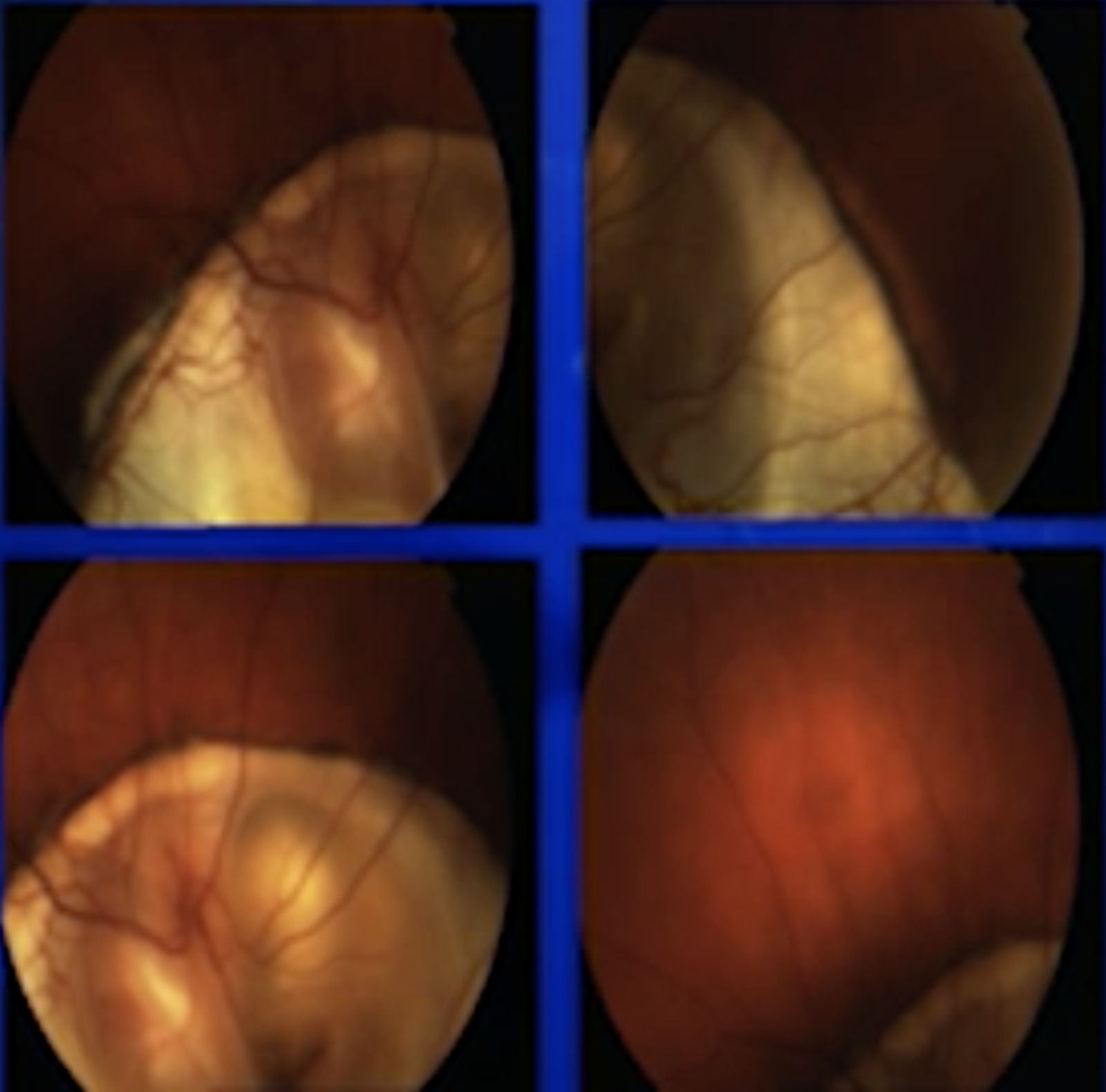 Coloboma & Retinal Detachment