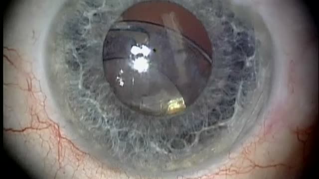 Single Suture Iris to Capsulorhexis Fixation for Late In-The-Bag Lens Subluxation