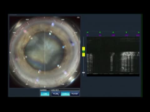 Femtosecond Surgery for White Cataract with Nystagmus