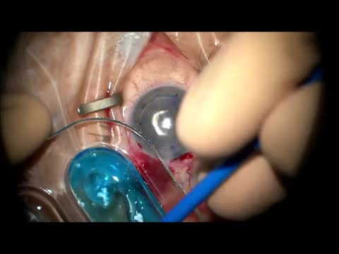 Surgical Pearls for ReSure Sealant