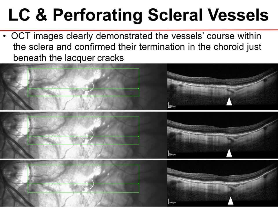 OCT-A Case Report: Implications of Lacquer Cracks for Perforating Vessels in Pathologic Myopia