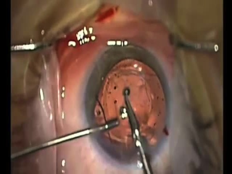 Mushroom Tip and Flip - Intraocular Lens Exchange