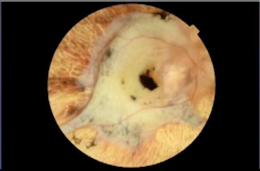 Massive Subretinal Hemorrhage