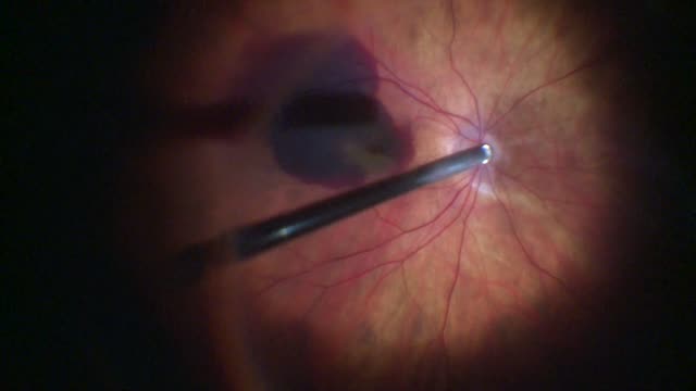 Submacular Hemorrhage