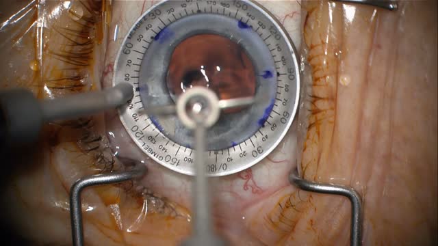 Gore-tex Sutured enVista IOL for Aphakia