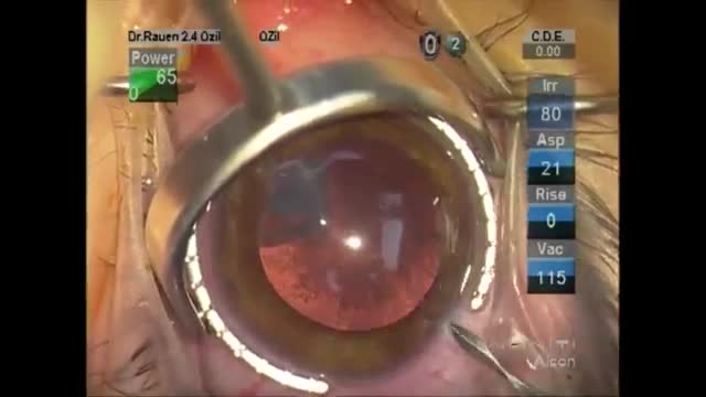 Cataract Surgery and Cornea Laceration Repair After Trauma