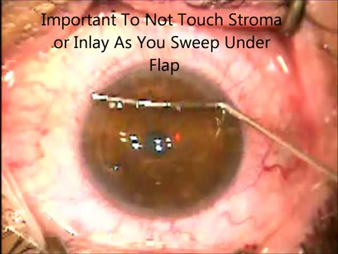 Technique for Raindrop Near Vision Inlay Insertion