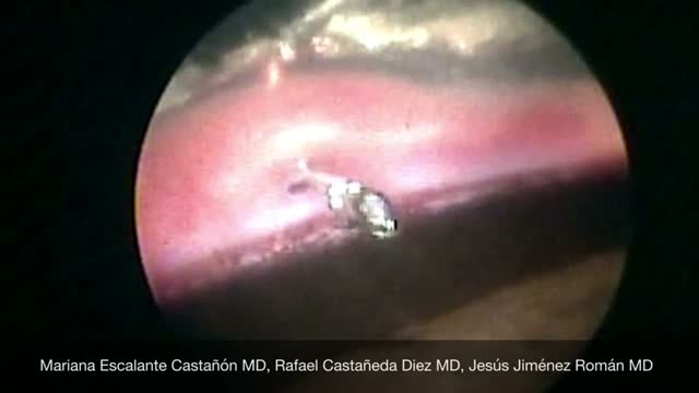 Express Shunt from Inside Anterior Chamber View
