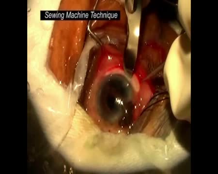Sewing Machine Technique for Iridodialysis Repair