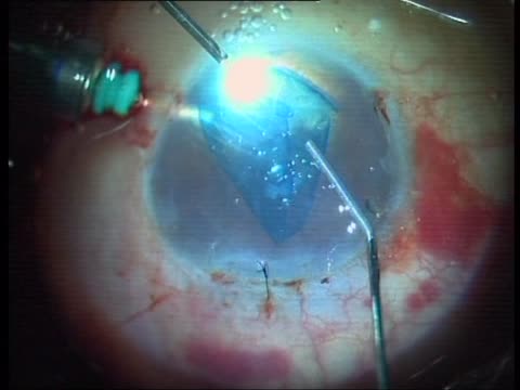 PDEK Live Surgery APOS 2015