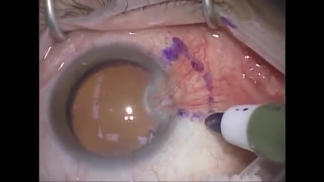 Pterygium Surgery with Amniotic Membrane (AMT)