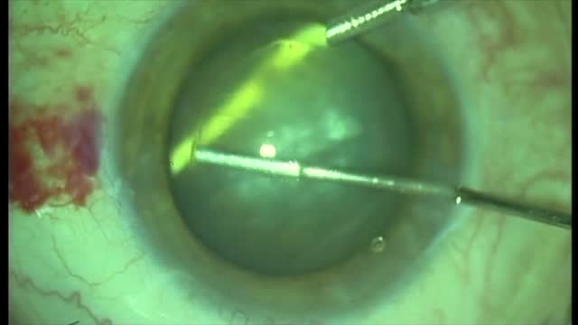 Management of Intralenticular Dexamethosone Implant