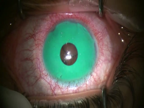 Removal of Cosmetic Iris