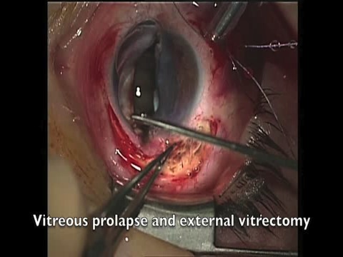 Blunt Ocular Trauma with Vitreous Prolapse