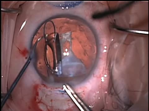 Traumatic Cataract Extraction with Repair of Traumatic Mydriasis and Iridodialysis