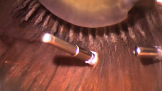 Cannula Effect on Pars Plana Epithelium