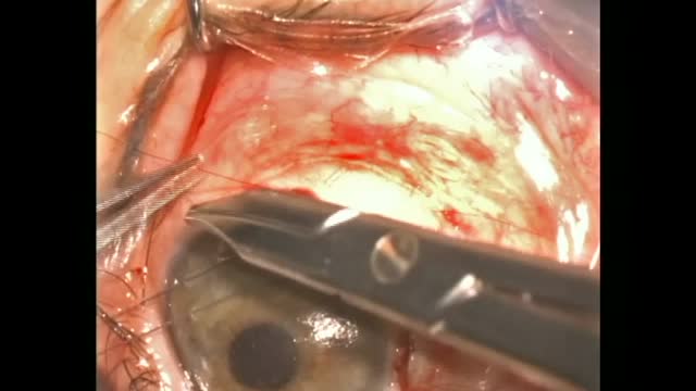 Resolving a Cyclodialysis Cleft After Trabeculotomy