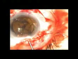 Inject first and then fixate hydrophobic single piece ALCON AcrySof IOL