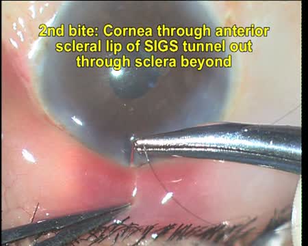 SIGS Releasable Suture