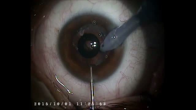Cataract Surgery Under a KAMRA Inlay