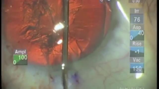 Soft Shell in Cataract Surgery