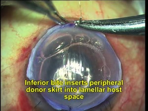 Tucked in Lamellar Keratoplasty with Phaco in Severe Pellucid Marginal Degeration