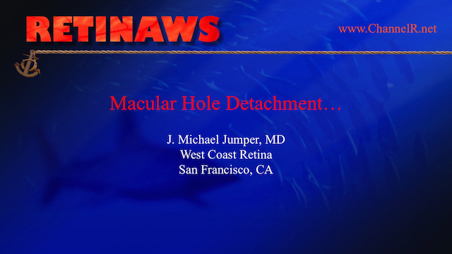 Macular Hole Detachment