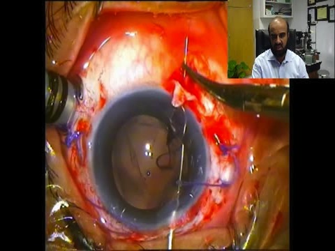 PPV with IOL Exchange and Scleral Fixation