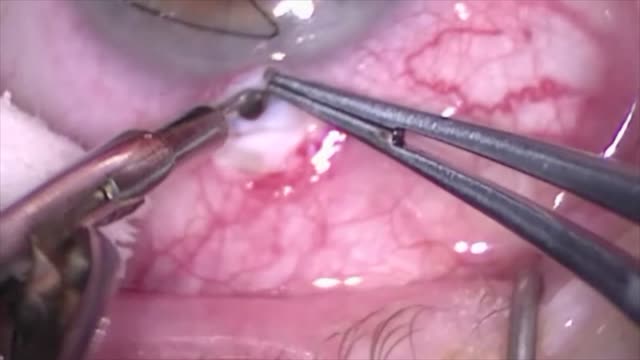 Trabeculectomy Technique to Minimize Induced Astigmatism