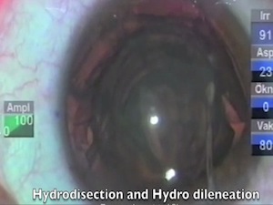 Tips on Toric IOL Implantation