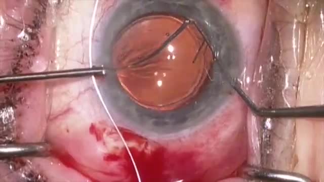 Lasso of IOL/capsular bag with Gore Tex suture