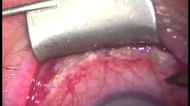 Conjunctivochalasis Treatment with Ellman Radiofrequency Surgery