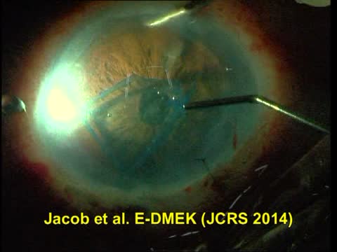 E-PDEK with 5-Year-Old Donor Graft in Failed DSAEK