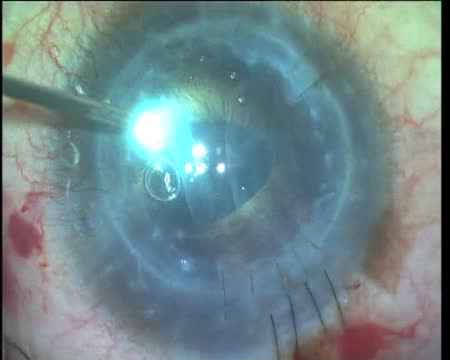 E-PDEK with Phacoemulsification in Failed Penetrating Keratoplasty Graft 