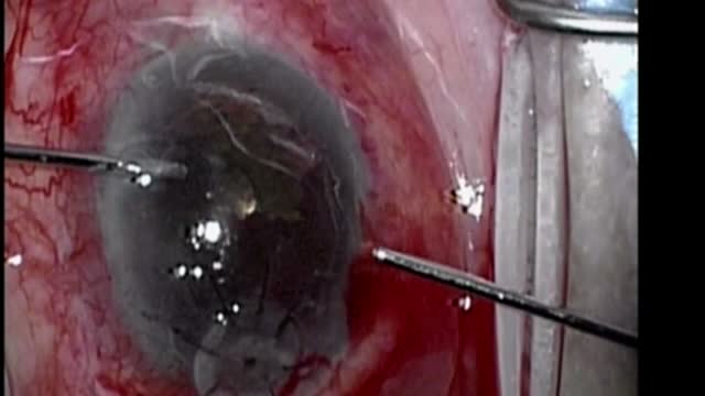 Lamellar Keratoplasty for Corneal Perforation