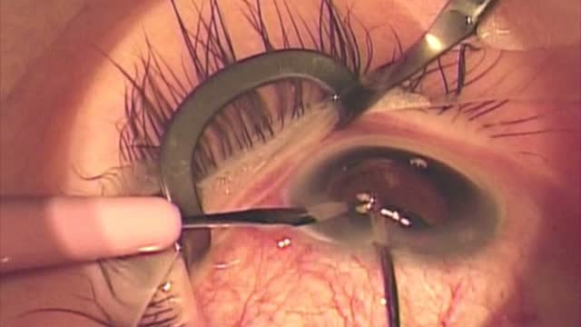 Ab Interno Removal of a Malpositioned Ex-Press Shunt