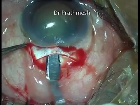 What to Do When: Steps to Manage Complication during Manual SICS Surgery