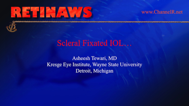 Scleral Fixated IOL