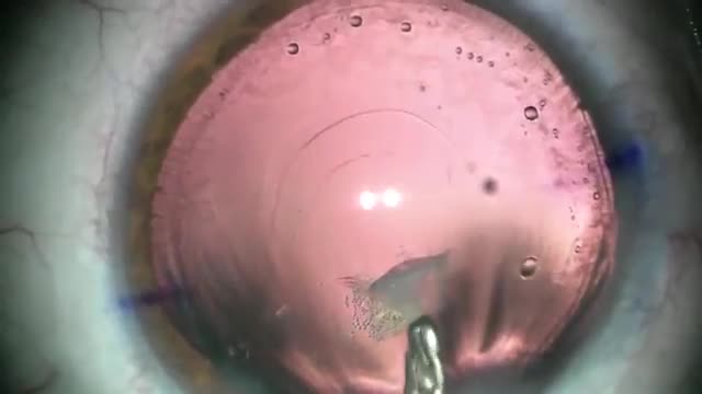 PCCC for Fibrotic Plaque and Residual Silicone Oil Removal (Part 1)
