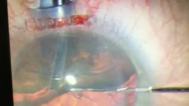 Phacoemulsification in Fuchs' Endothelial Dystrophy